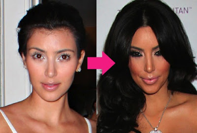 kim-kardashian-before-and-after-surgery-photos.jpg