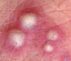 Pustule.jpg