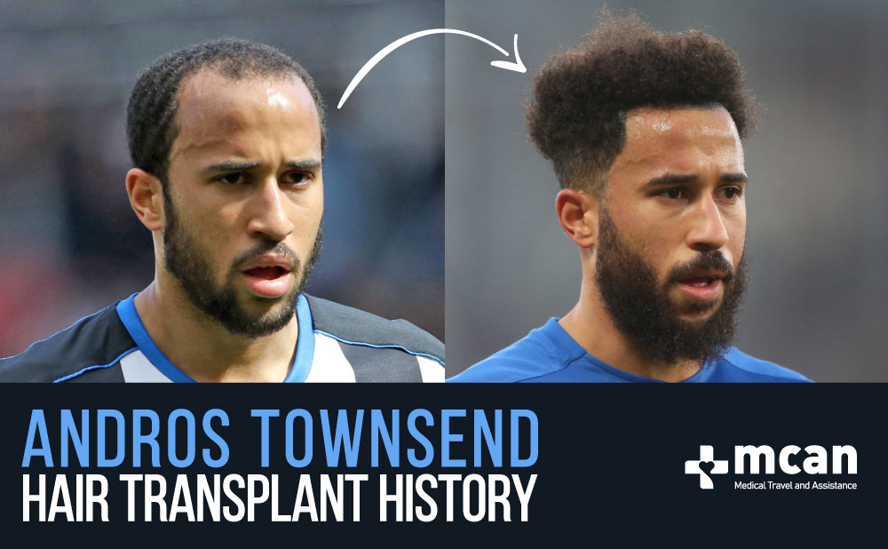 Andros-Townsend-Hair-Transplant-History-COVER.jpg