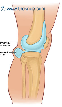 bakers-cyst3.jpg