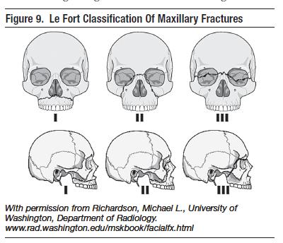 Figure%209.%20Le%20Fort%20Classification%20Of%20Maxillary%20Fractures%20Emergency%20medical%20Practice.jpg