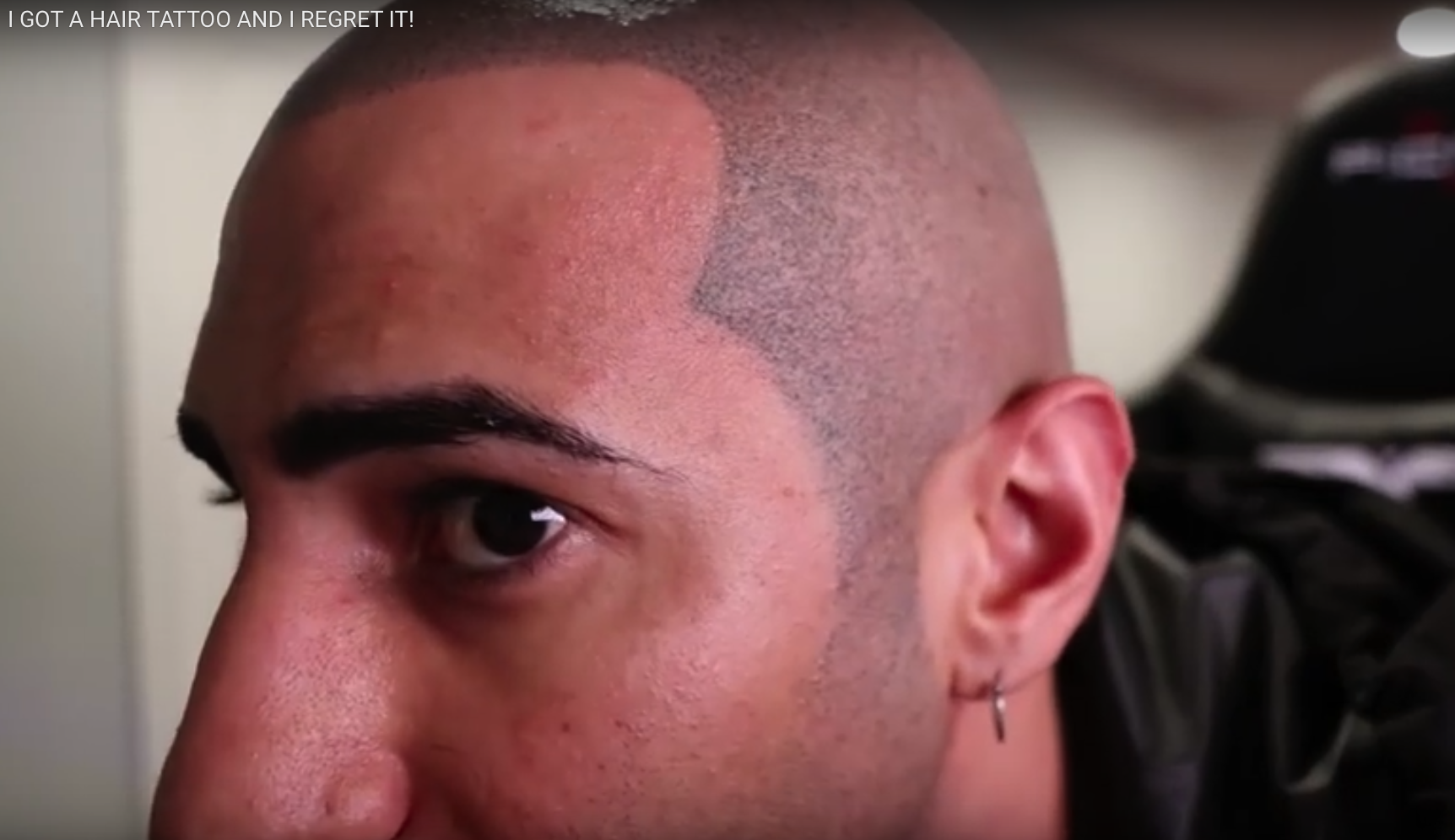 scalp-micropigmentation-regrets-youtuber.png