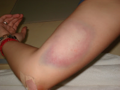 initial+bruise.JPG